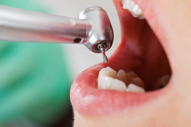 Best Emergency Dental Care for Abscessed Tooth in Mapleton, UT